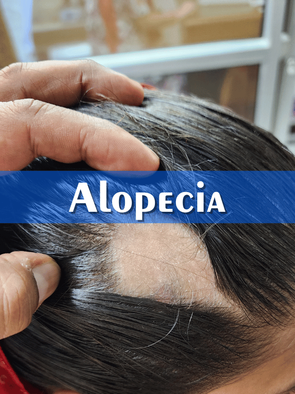 Alopecia Treatment 